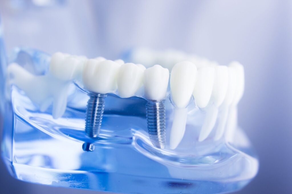 Implantes dentales