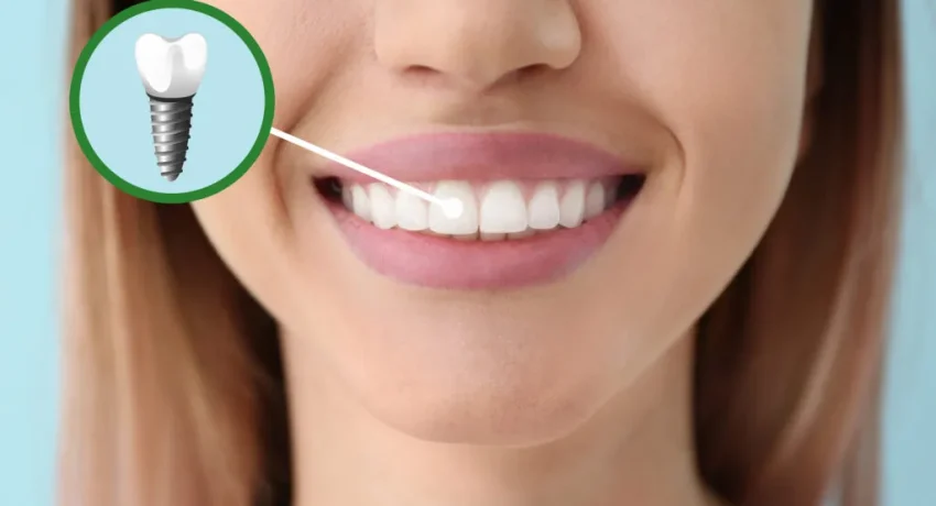 Precio-implantes-dentales-1024x667